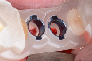 guided dental surgery